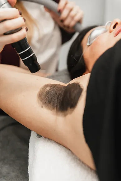 carbon peeling de axilas